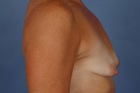 Breast Augmentation Before & After Image