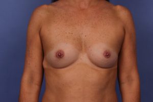 Breast Augmentation Before & After Image