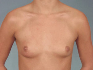 Breast Augmentation Before & After Image