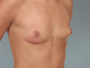 Breast Augmentation Before & After Image