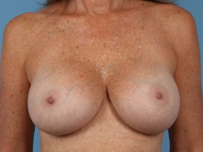 Breast Augmentation Before & After Image