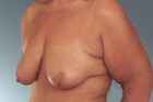 Breast Lift Before & After Image