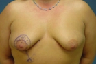 Breast Lift Before & After Image