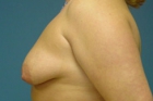 Breast Lift Before & After Image