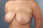 Breast Lift Before & After Image