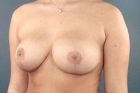 Breast Lift Before & After Image