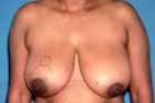 Breast Reduction Before & After Image