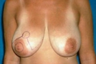 Breast Reduction Before & After Image