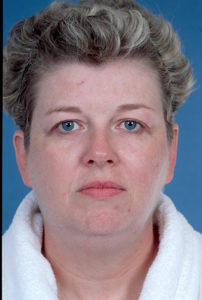 Blepharoplasty Before & After Image