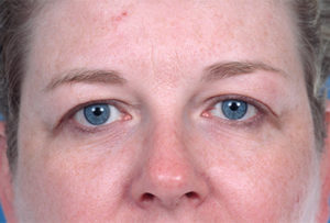 Blepharoplasty Before & After Image