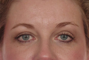 Blepharoplasty Before & After Image