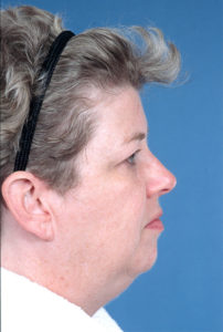 Blepharoplasty Before & After Image