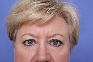 Blepharoplasty Before & After Image