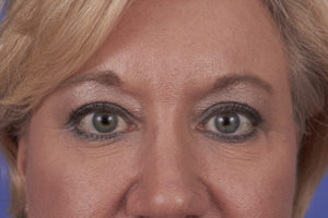 Blepharoplasty Before & After Image