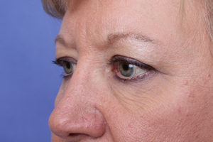 Blepharoplasty Before & After Image