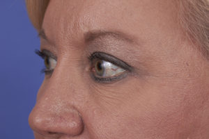 Blepharoplasty Before & After Image