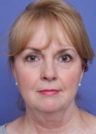 Blepharoplasty Before & After Image