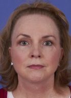 Blepharoplasty Before & After Image