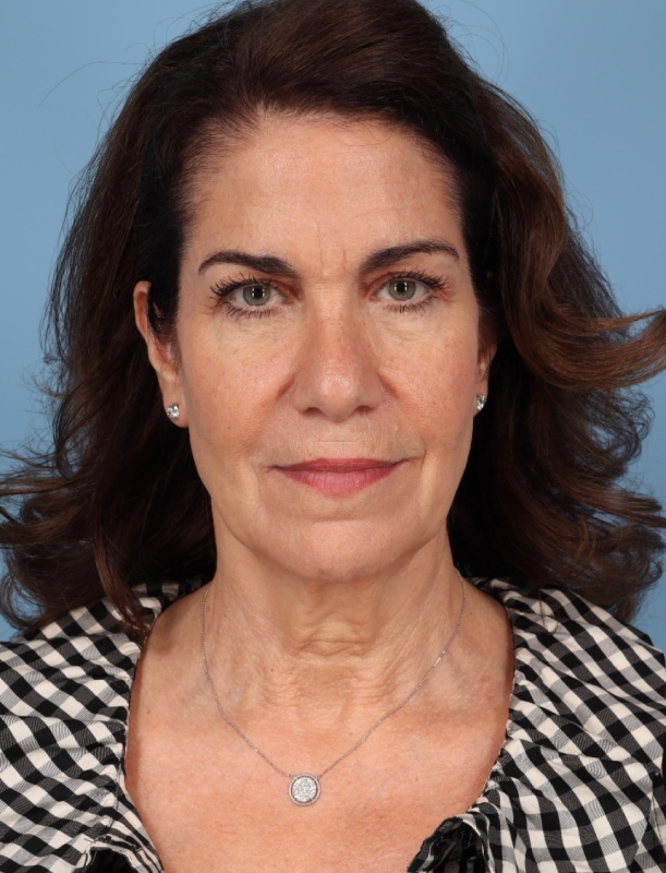 Blepharoplasty Before & After Image