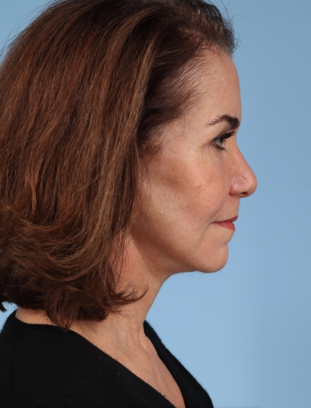 Blepharoplasty Before & After Image