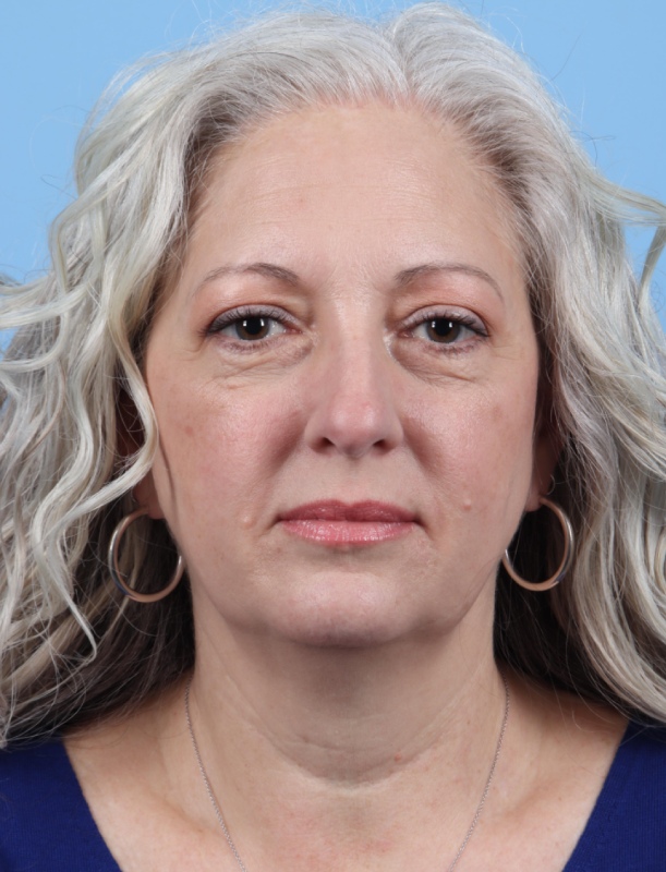 Blepharoplasty Before & After Image