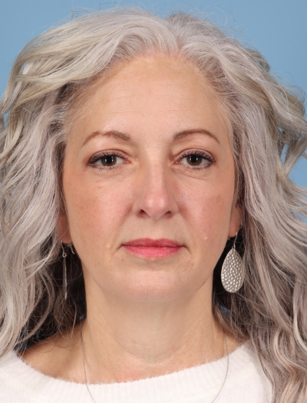Blepharoplasty Before & After Image