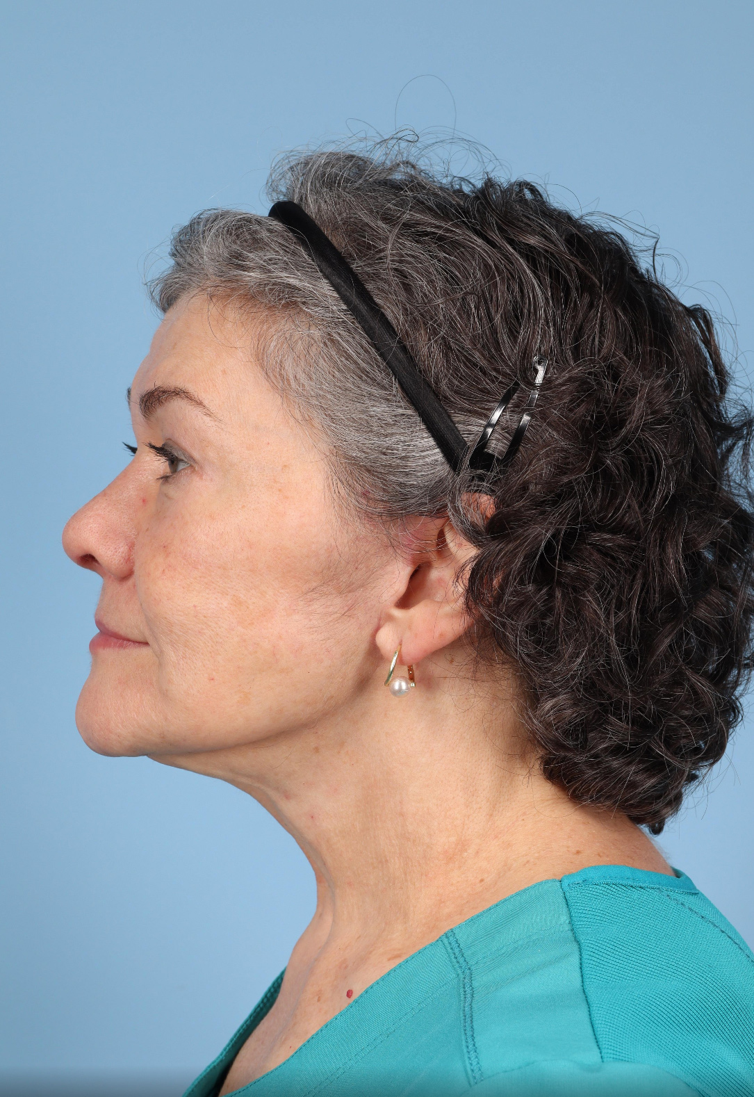 Blepharoplasty Before & After Image