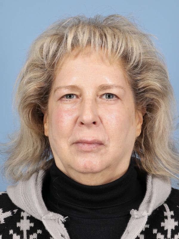 Blepharoplasty Before & After Image