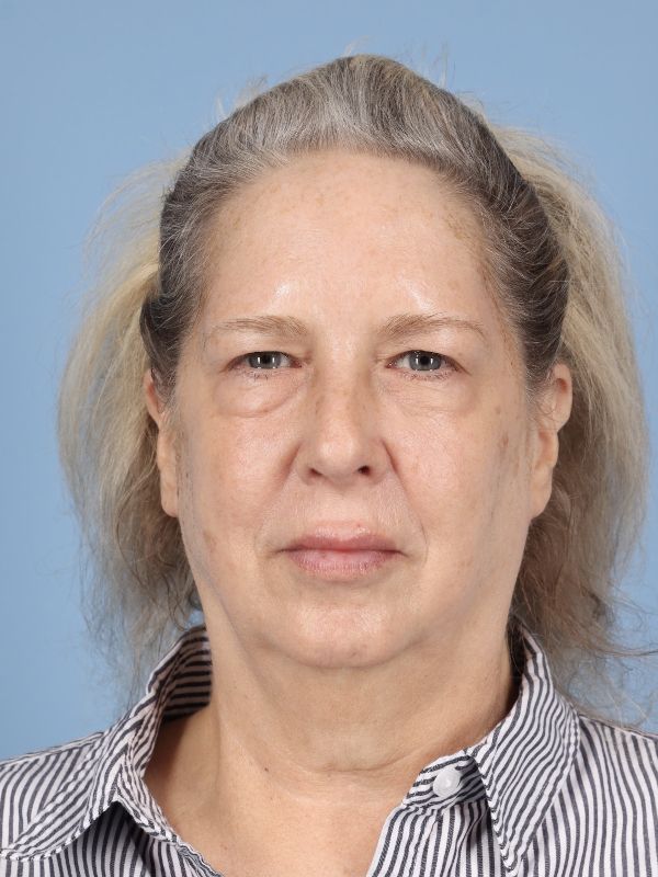Blepharoplasty Before & After Image