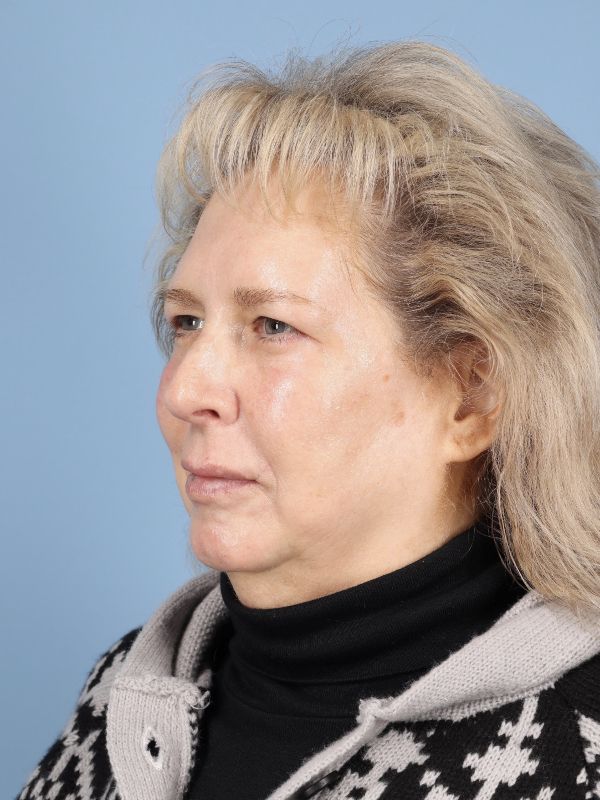Blepharoplasty Before & After Image