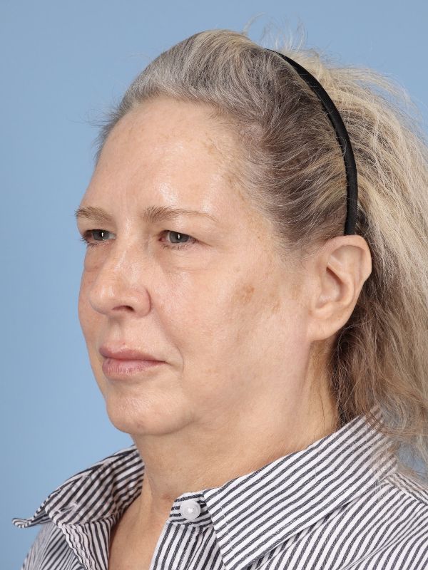 Blepharoplasty Before & After Image