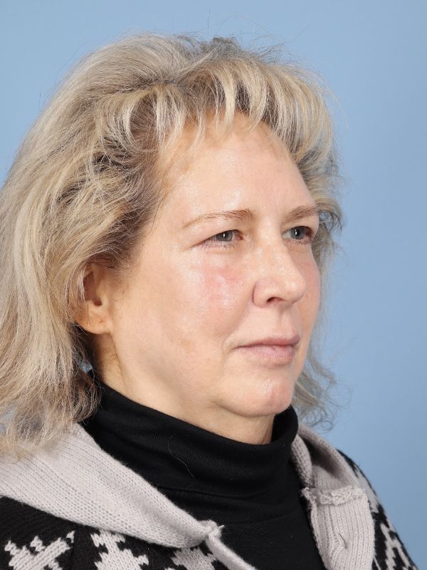 Blepharoplasty Before & After Image