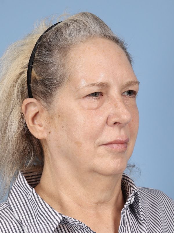 Blepharoplasty Before & After Image