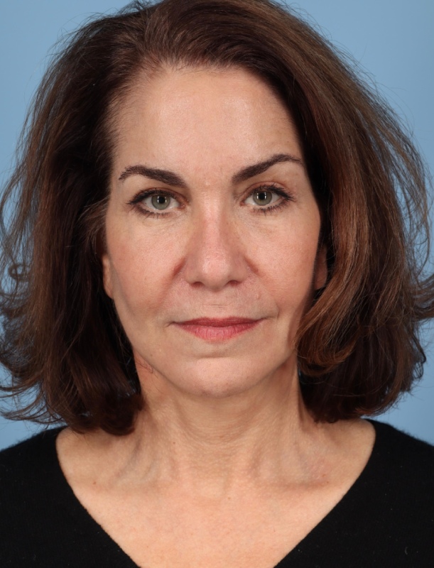 Brow Lift Before & After Image