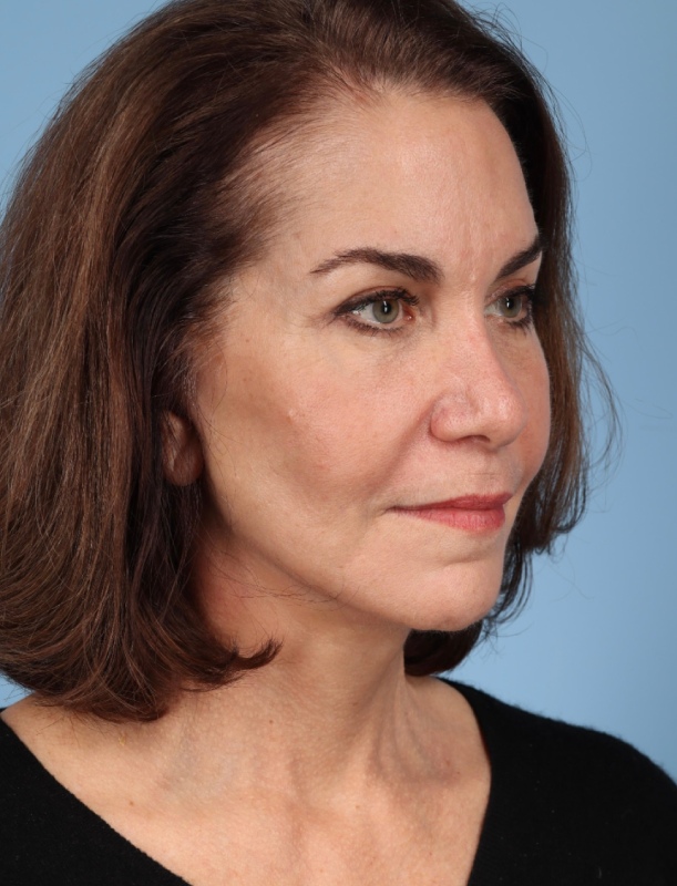Brow Lift Before & After Image