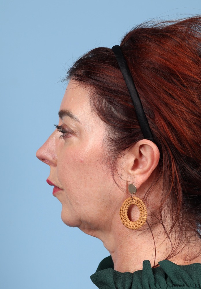 Brow Lift Before & After Image