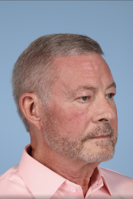 Brow Lift Before & After Image