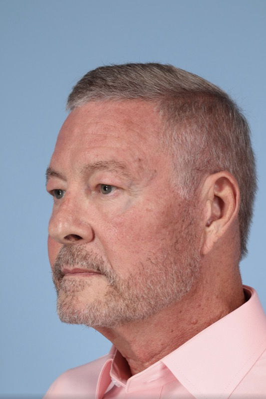 Brow Lift Before & After Image