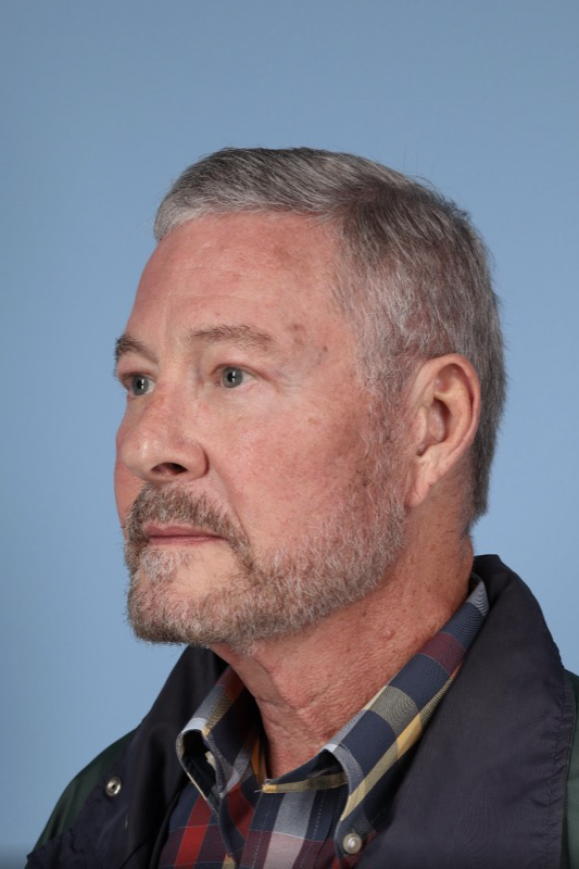 Brow Lift Before & After Image