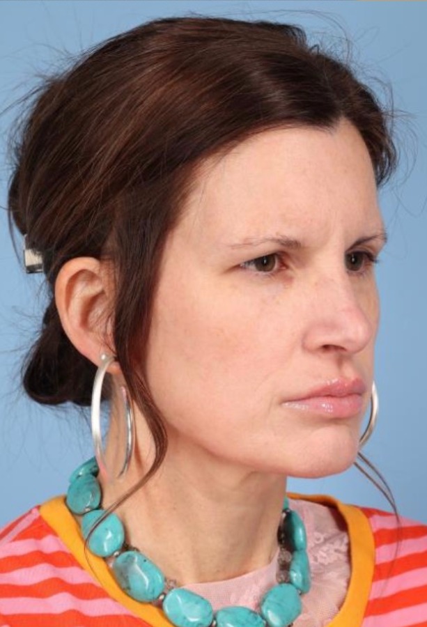 Brow Lift Before & After Image
