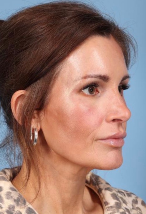 Brow Lift Before & After Image