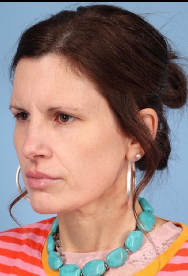 Brow Lift Before & After Image