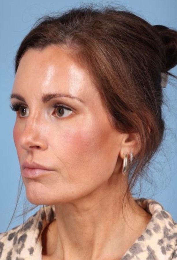 Brow Lift Before & After Image