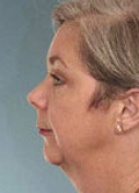 Facelift Before & After Image