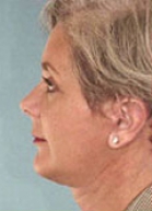 Facelift Before & After Image