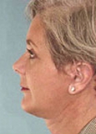 Facelift Before & After Image