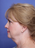 Facelift Before & After Image