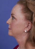 Facelift Before & After Image