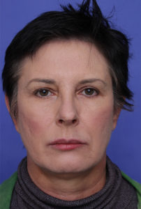 Facelift Before & After Image