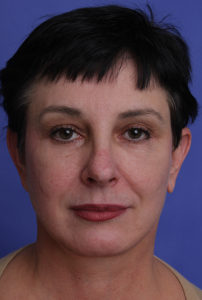 Facelift Before & After Image